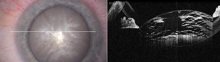 Набухающая катаракта при сканировании iOCT®