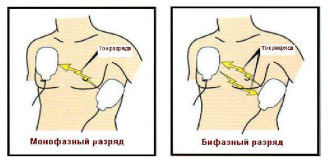 Бифазный дефибриллятор что это значит. Смотреть фото Бифазный дефибриллятор что это значит. Смотреть картинку Бифазный дефибриллятор что это значит. Картинка про Бифазный дефибриллятор что это значит. Фото Бифазный дефибриллятор что это значит