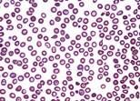 Клетки крови человека, страдающего талассемией (светлое поле)