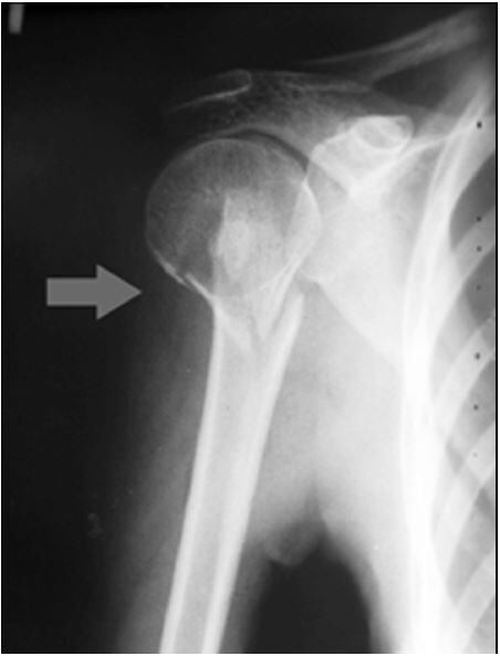 Рентгенограмма больного А. с переломом хирургической шейки плечевой кости