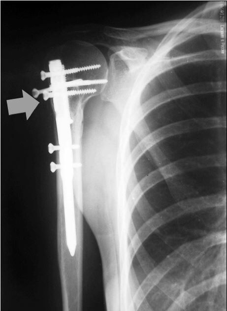 Рентгенограмма больного А. после остеосинтеза перело- ма хирургической шейки плечевой кости блокируемым штиф- том