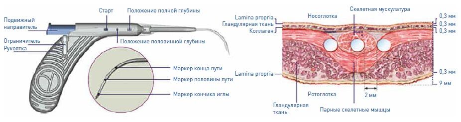 Конструкция системы Pillar, носоглотка
