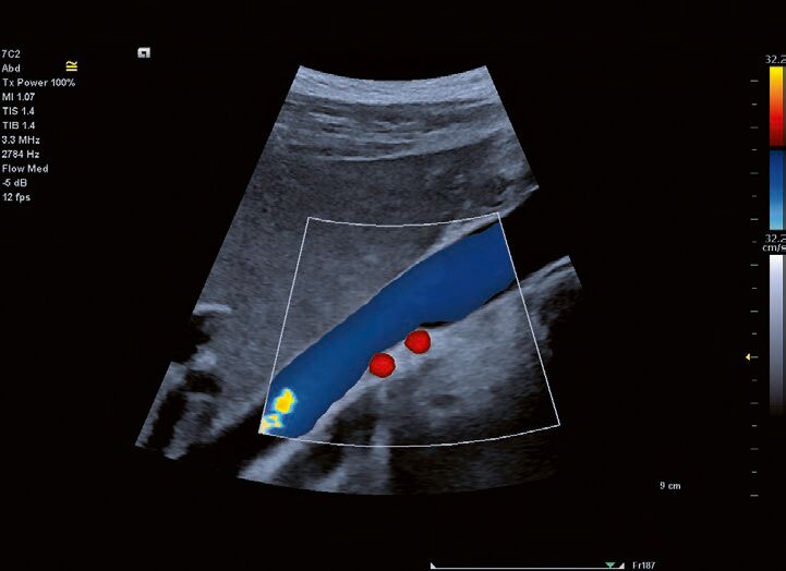 Сагиттальное изображение нижней полой вены и сдвоеной правой почечной артерии