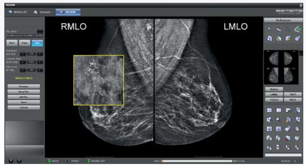 Digital Mammography Pinkview sale