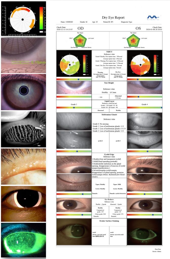 Протокол диагностики сухого глаза