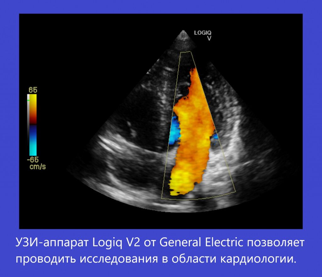 Ультразвуковой аппарат Logiq V2. Исследования в области кардиологии