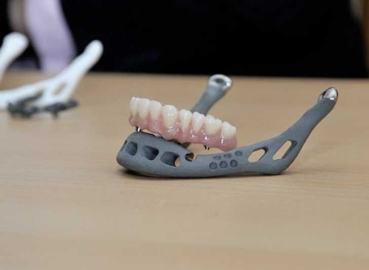 3D-printed-lower-jaw-implant.jpg