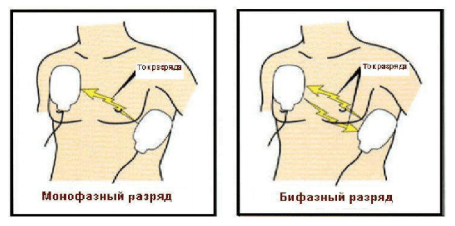 что такое дефибриллятор кардиосинхронизированный. Смотреть фото что такое дефибриллятор кардиосинхронизированный. Смотреть картинку что такое дефибриллятор кардиосинхронизированный. Картинка про что такое дефибриллятор кардиосинхронизированный. Фото что такое дефибриллятор кардиосинхронизированный