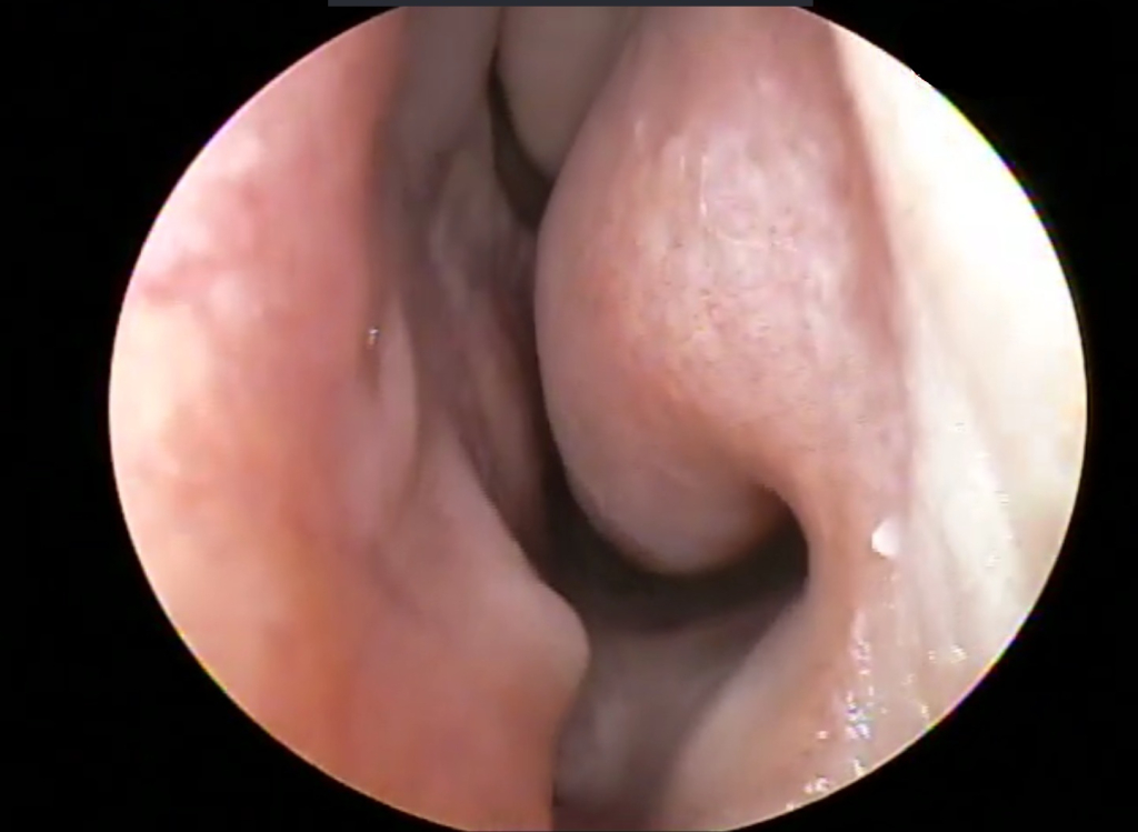 Искривлённая перегородка Искривлённая перегородка