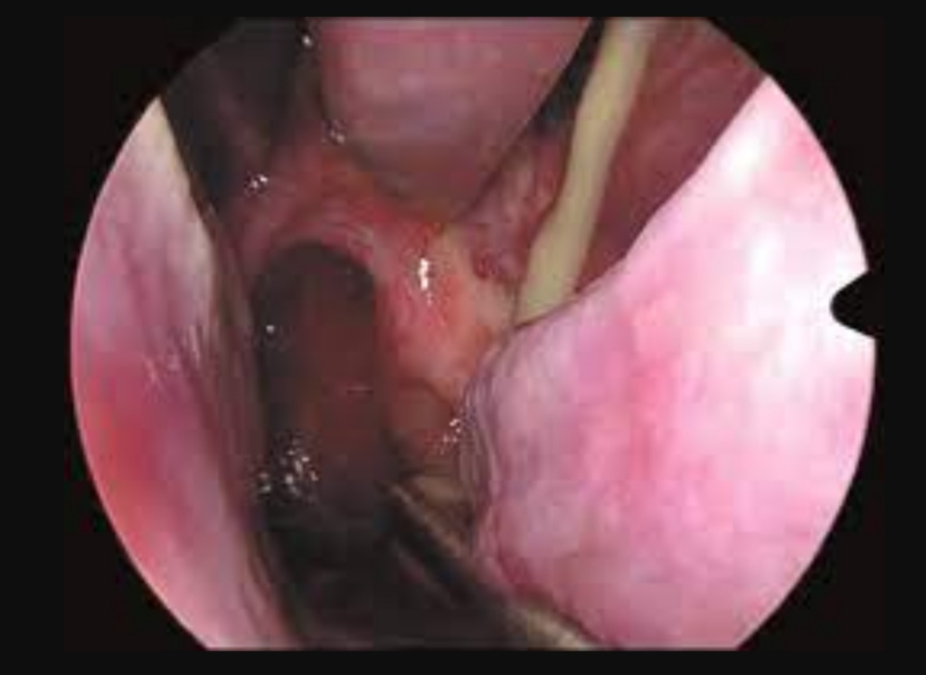 Нос воспаление Нос воспаление