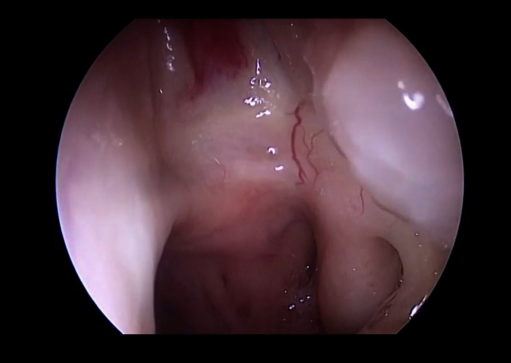 Чистый нос Чистый нос