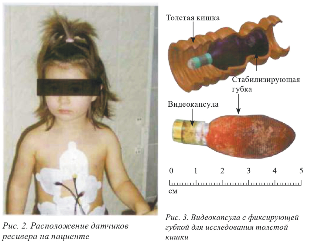 Расположение датчиков ресивера | Видеокапсула с фиксирующей губкой