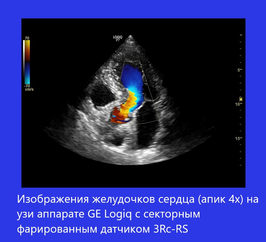 Желудочки сердца (апик 4x) на Logiq с датчиком 3Rc-RS