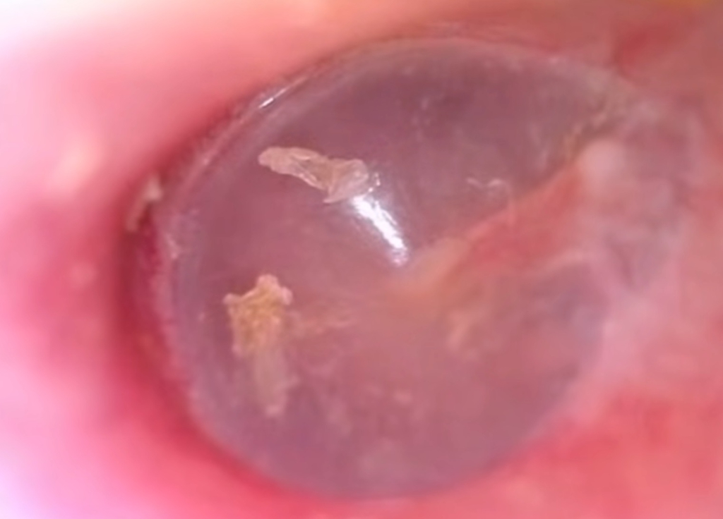 Барабанная перепонка Барабанная перепонка