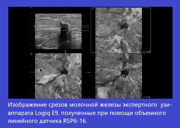 Изображения срезов молочной железы экспертного УЗИ Logiq E9 с линейным датчиком RSP6-16