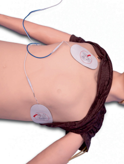 Рис. 1. Правильное наложение электродов при дефибрилляции Рис. 1. Правильное наложение электродов при дефибрилляции