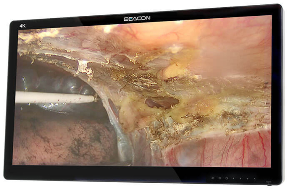 Хирургический монитор сверхвысокой чёткости Beacon S5583P(L) 55"